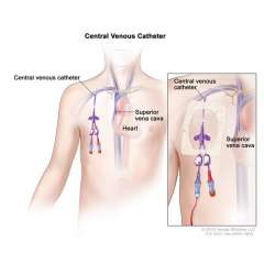 Buy Central Venous Catheter in Kenya